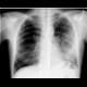 Tuberculosis, TB, endobronchial spread, tree in bud, cavity Tuberculosis, TB, endobronchial spread, tree in bud, cavity: X-ray - Plain radiograph